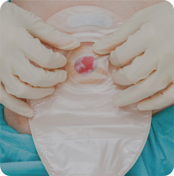 Cursos y talleres de Sondas y Ostomías 